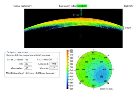 thickness measurement cornea cpt code|cpt code for optical pachymetry.